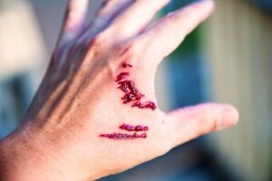 How Do I Receive Maximum Compensation for Scarring as a Result of a Dog Bite?