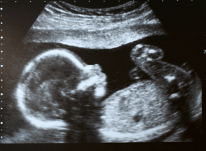 Birth Injury Lawyers in Philadelphia